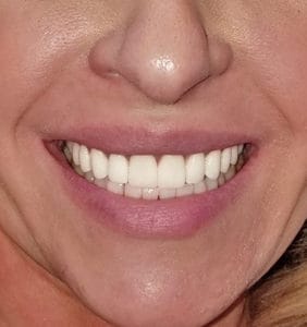 Case Study - Cosmetic Dentistry After Image