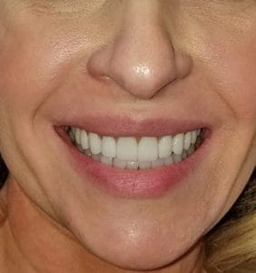 Case Study - Cosmetic Dentistry After Image
