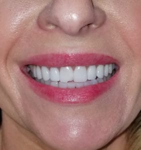 Case Study - Cosmetic Dentistry After Image