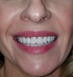 Case Study - Cosmetic Dentistry After Image