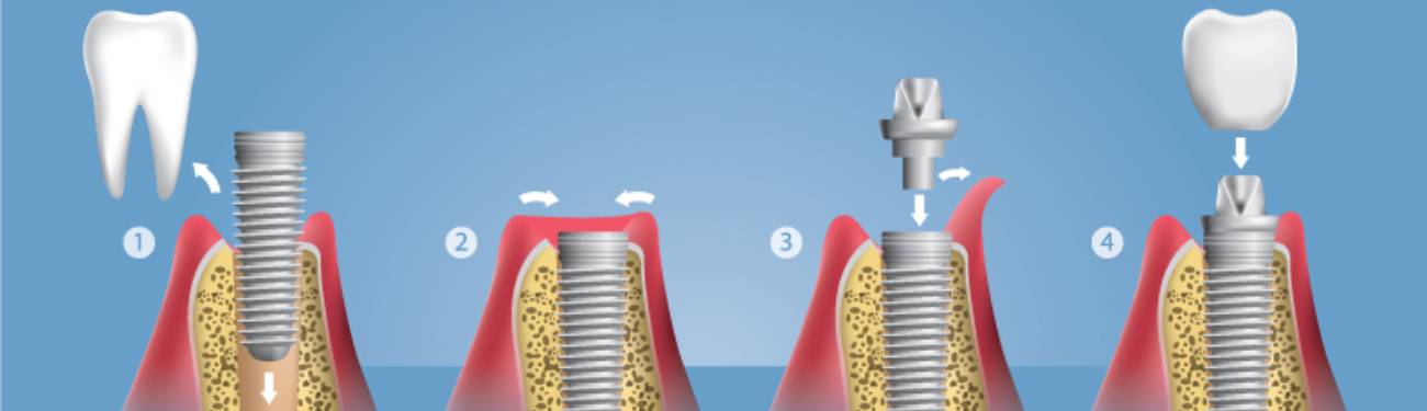 What are Dental Implants and does my insurance cover them?
