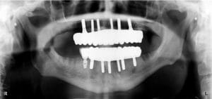 zirconia implant x-ray