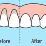 gum recession before and after