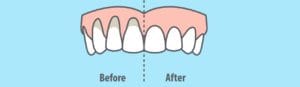 gum recession before and after