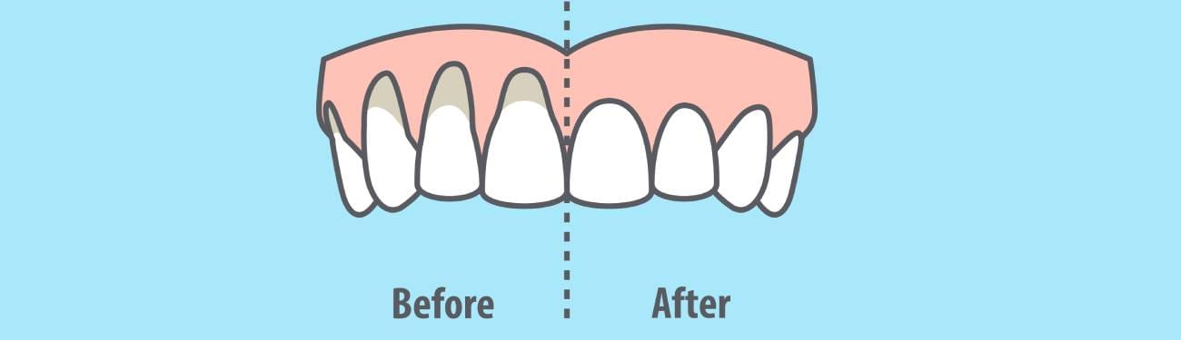 Gum Recession