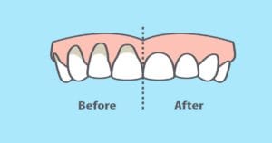 gum recession before and after