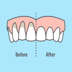 gum recession before and after