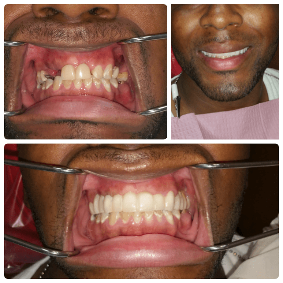 Clock Tower Dental | Veneers Before & After