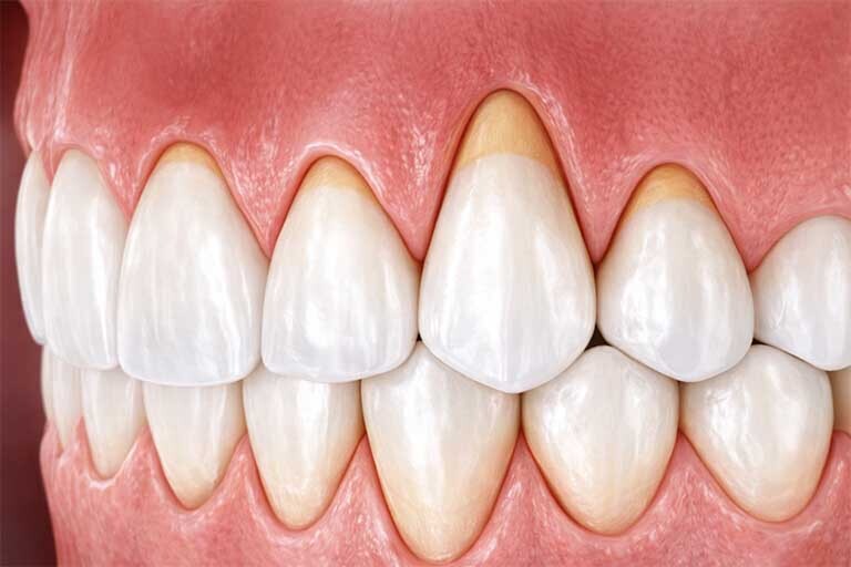 Dental illustration of gum recession with exposed tooth roots treated at Franklin Square NY dental clinic