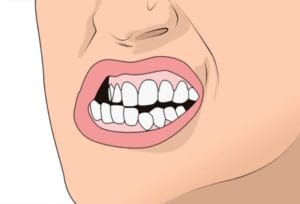 teeth grinding