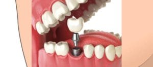 dental implants