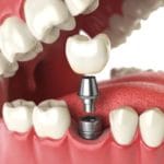 dental implant