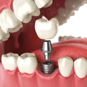 dental implants