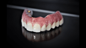 Clocktower Dental | Zirconia Bridge