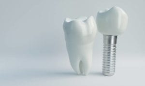 Dental Implants