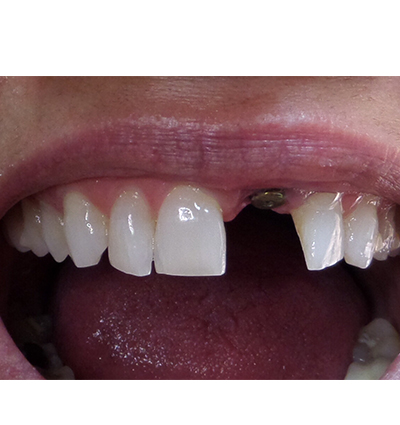 Dental Implants – Case 19