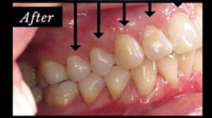 Clocktower Dental | Pinhole Surgical Technique