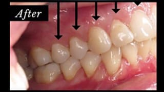 Clocktower Dental |  Pinhole Surgical Technique