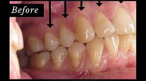 Clocktower Dental | Pinhole Surgical Technique