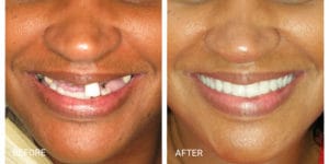 Franklin Square Dentist - before and after