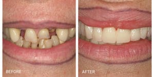 Franklin Square Dentist - before and after