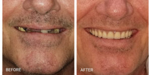 Franklin Square Dentist - before and after
