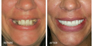 Franklin Square Dentist - before and after