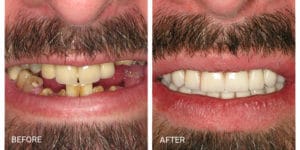 Franklin Square Dentist - before and after