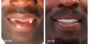 Franklin Square Dentist - before and after