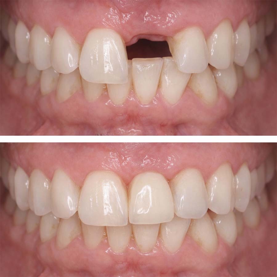 Smile in a Day dental implants before and after showing replacement of missing front tooth with natural-looking implant crown and balanced gum tissue