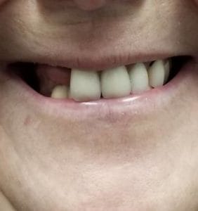 Smile in a Day - Case 7 - before
