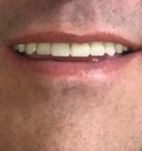 Smile in a Day - Case 3 - after