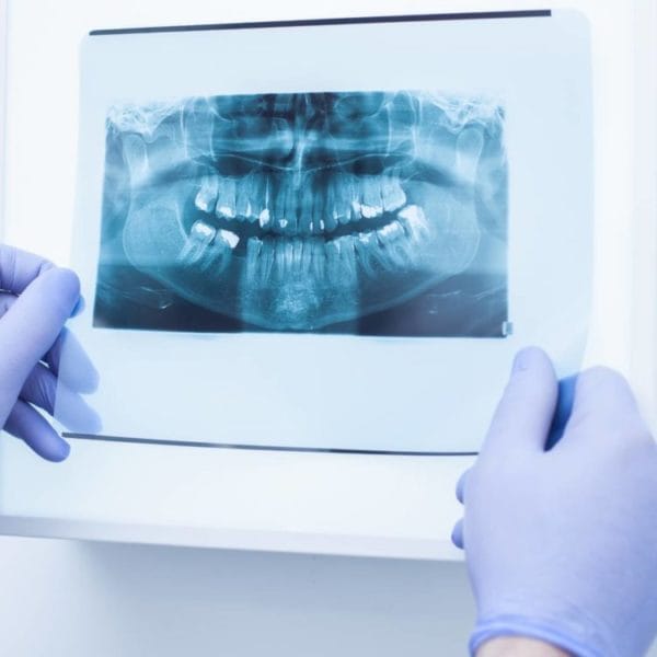 Are Dental X-Rays Safe?