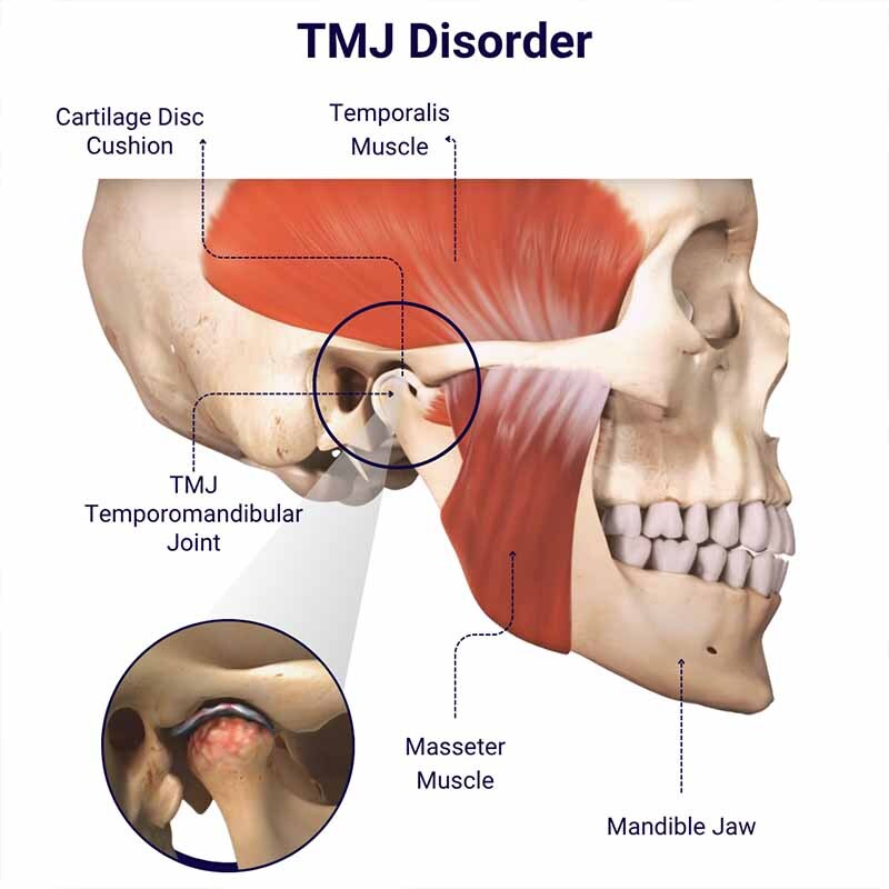 Temporomandibular joint TMJ disorder anatomy diagram showing jaw joint, muscles, and cartilage disc with highlighted pain area