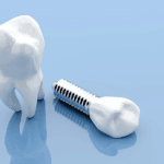 dental implants