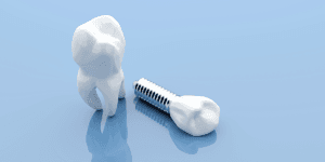 dental implants