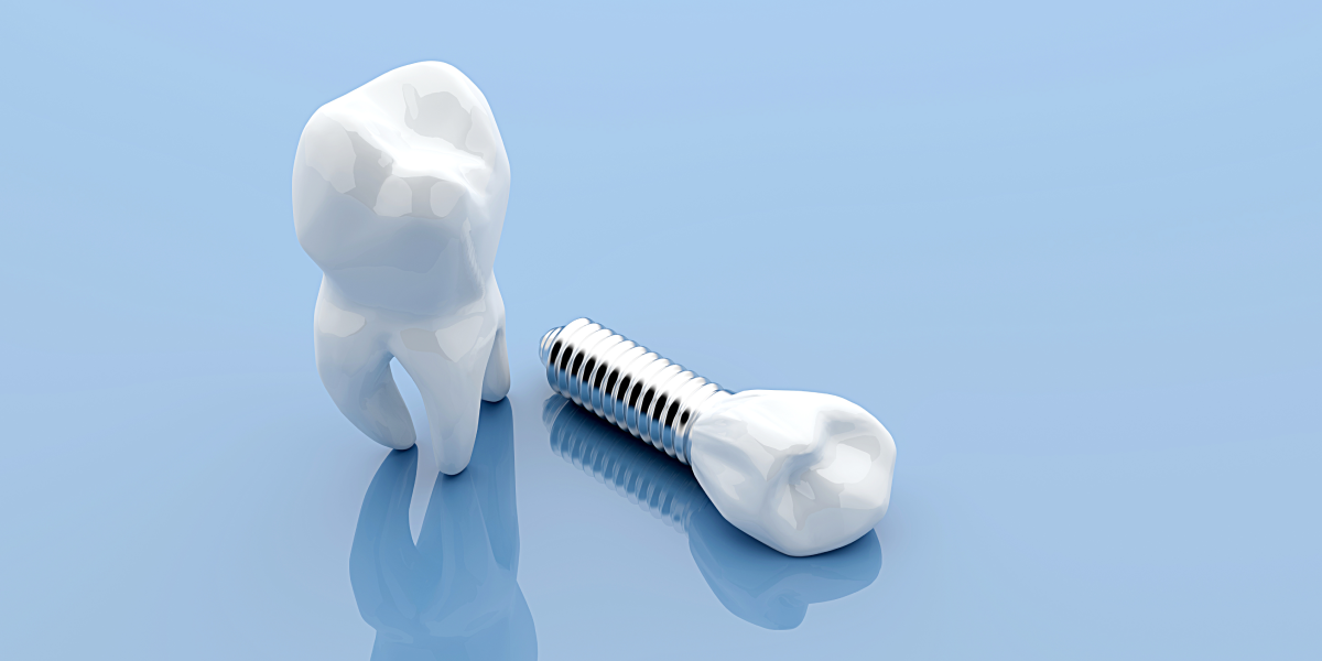 What are Dental Implants and Why Are They So Popular?