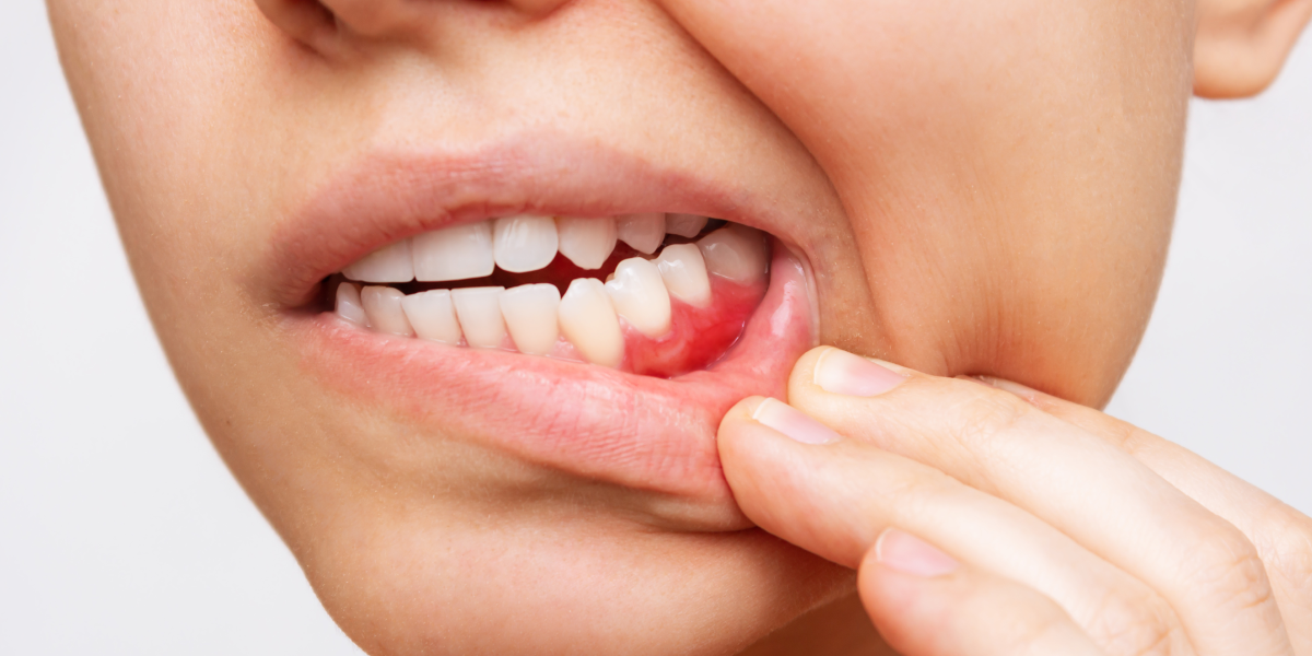 You Need Gum Surgery. What You Need To Know About The LANAP® Procedure
