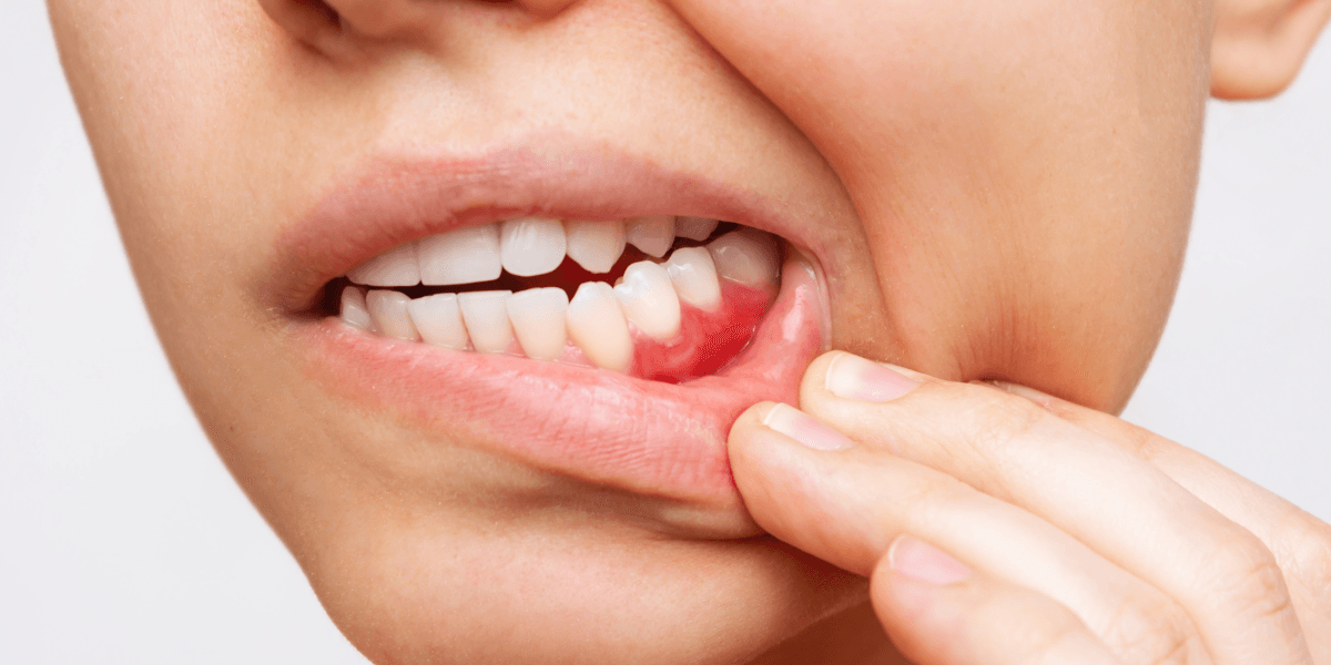 You Need Gum Surgery. What You Need To Know About The LANAP® Procedure