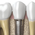 dental implants