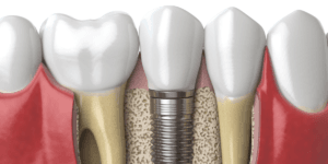 dental implants