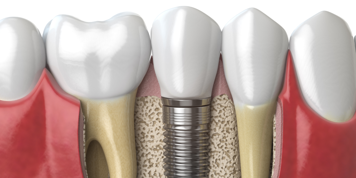 Are You Having Dental Implant Surgery? Here’s What You Can Expect