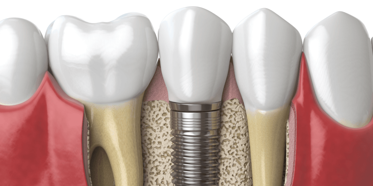 Are You Having Dental Implant Surgery? Here’s What You Can Expect