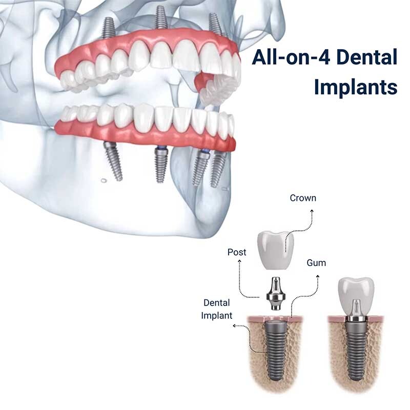 All-on-4 dental implants diagram showing full arch tooth replacement with implant posts, crowns, and gum structure