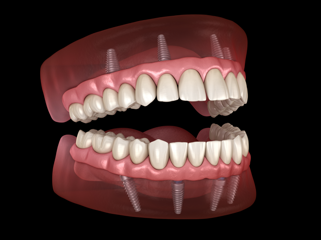 All-On-Four Dentures: Everything You Need to Know