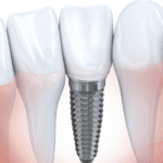 Dental implant