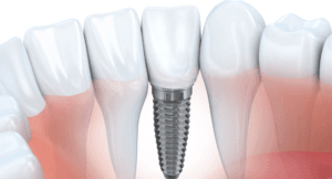 Dental implant