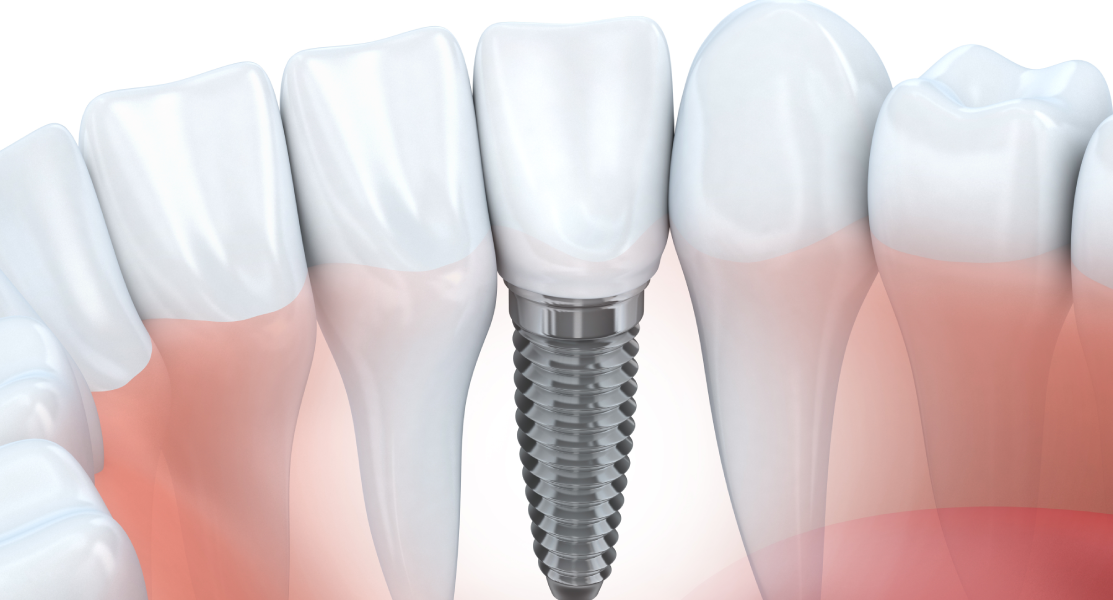 How You Can Choose the Right Dental Implant Specialist