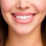 Woman with veneers