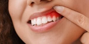 Gum Disease